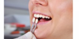 beneficios facetas dentales